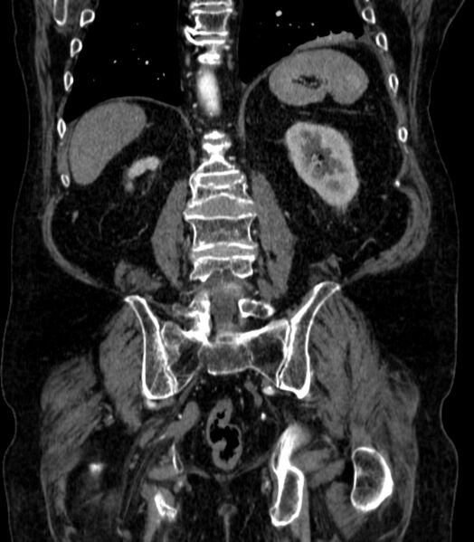 File:Abdominal aortic aneurysm (Radiopaedia 25855-26001 Coronal C+ arterial phase 56).jpg