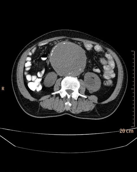 File:Abdominal aortic aneurysm (Radiopaedia 25985-26121 Axial non-contrast 13).jpg