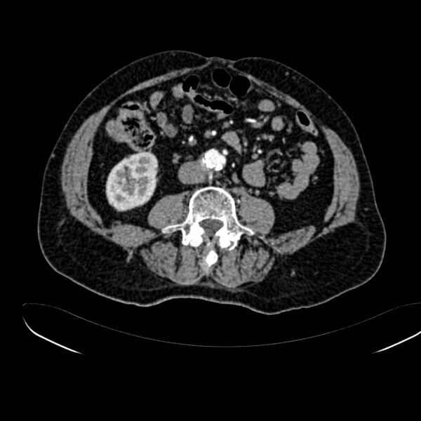 File:Abdominal aortic aneurysm (Radiopaedia 75131-86203 Axial C+ arterial phase 27).jpg
