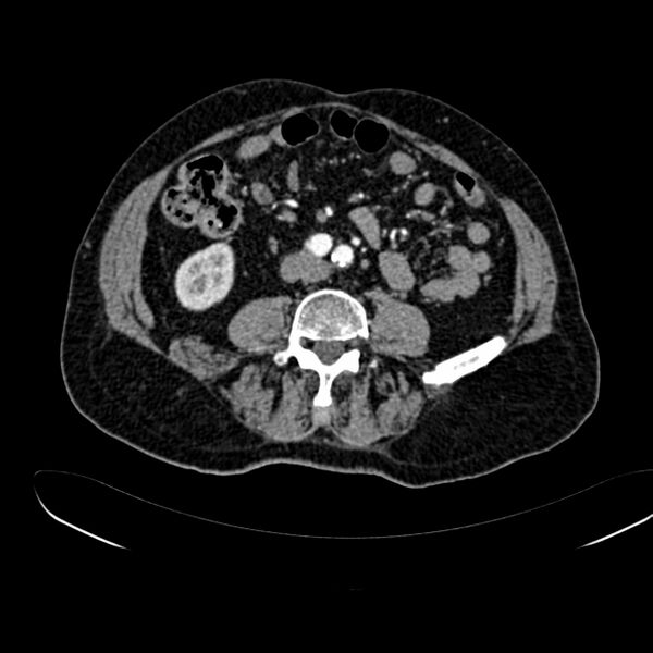 File:Abdominal aortic aneurysm (Radiopaedia 75131-86203 Axial C+ arterial phase 28).jpg