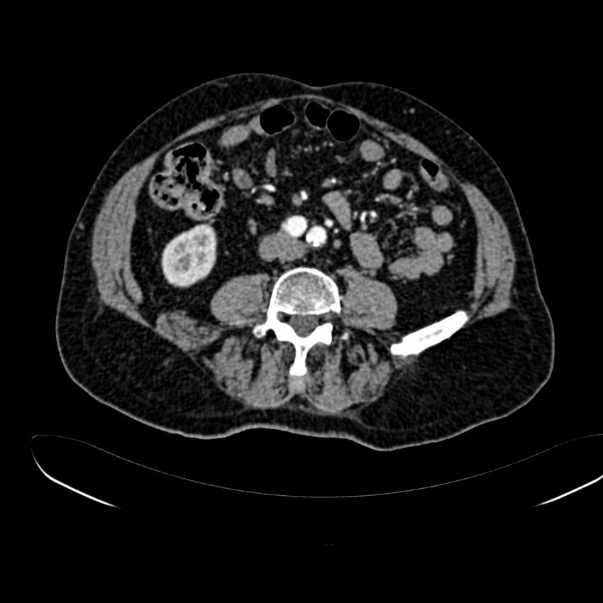 Abdominal aortic aneurysm (Radiopaedia 75131-86203 Axial C+ arterial phase 28).jpg