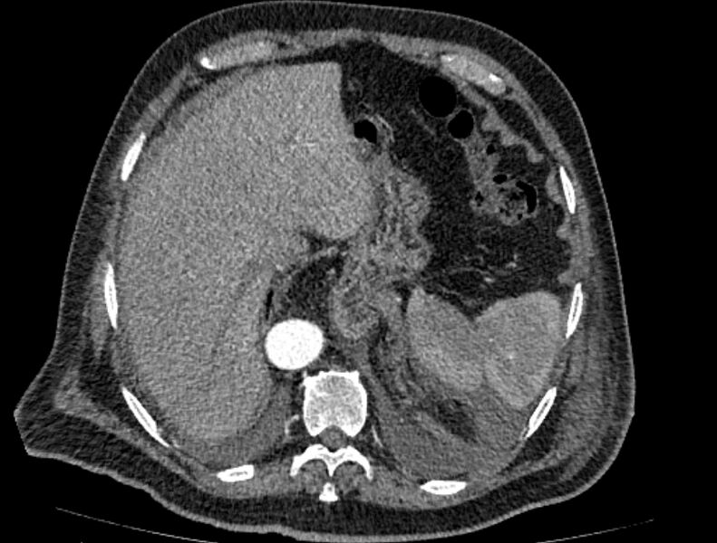 File:Abdominal aortic aneurysm rupture (Radiopaedia 54179-60362 Axial C+ arterial phase 20).jpg