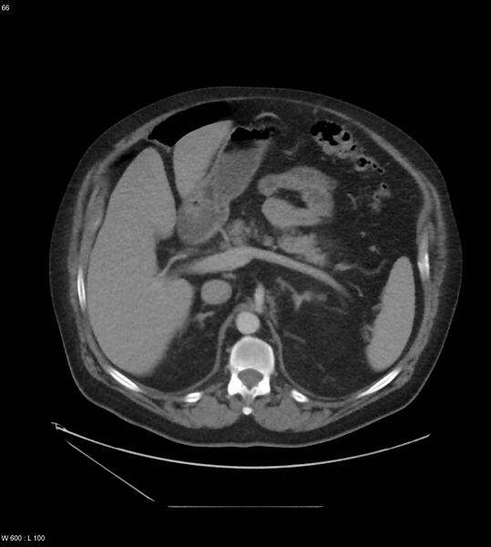 File:Abdominal aortic aneurysm with intramural hematoma then rupture (Radiopaedia 50278-55631 Axial C+ arterial phase 57).jpg