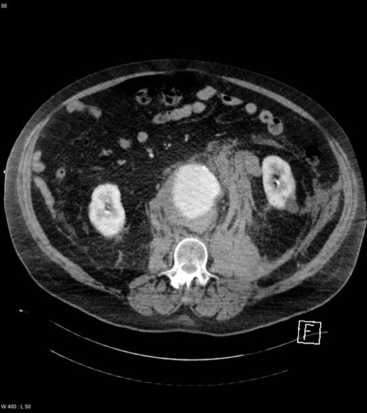File:Abdominal aortic aneurysm with intramural hematoma then rupture (Radiopaedia 50278-55632 Axial C+ arterial phase 85).jpg
