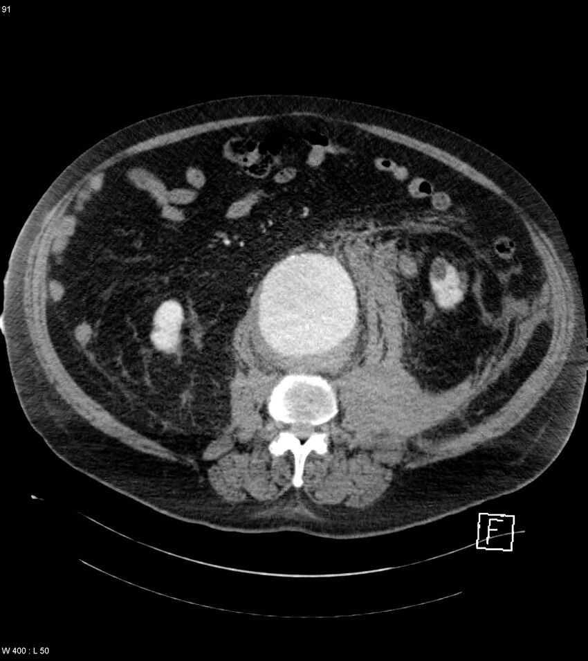 Abdominal aortic aneurysm with intramural hematoma then rupture (Radiopaedia 50278-55632 Axial C+ arterial phase 90).jpg