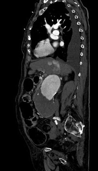 File:Abdominal aortic aneurysm with thrombus fissuration (Radiopaedia 73192-83919 Sagittal C+ arterial phase 86).jpg