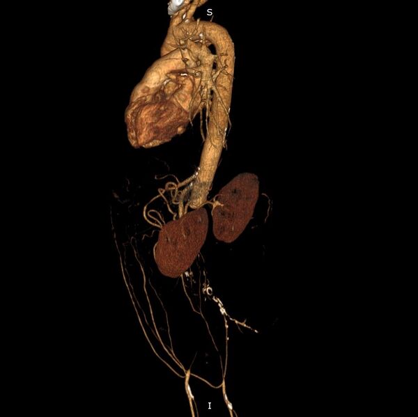 File:Abdominal aortic interposition tube graft and aneurysm thrombosis (Radiopaedia 71438-81857 3D VRT C+ arterial phase 6).jpg