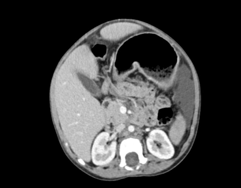 File:Abdominal premesenteric cystic lymphangioma (Radiopaedia 82995-97350 Axial C+ portal venous phase 23).jpg