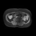 Abdominal wall endometriosis (Radiopaedia 83702-98847 Axial T1 C+ fat sat 9).jpg