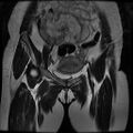 Abdominal wall endometriosis (Radiopaedia 83702-98847 Coronal T2 4).jpg