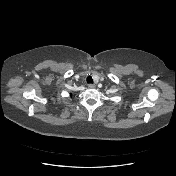File:Aberrant right subclavian and left vertebral arteries (Radiopaedia 43467-46847 Axial C+ portal venous phase 9).jpg