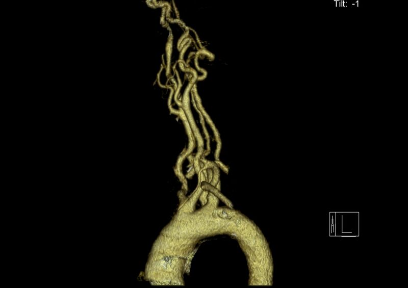 File:Aberrant right subclavian artery (Radiopaedia 19283-19294 3D reconstruction C+ arterial phase 13).jpg