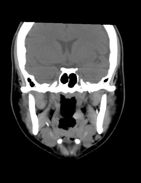 File:Accessory parotid glands (Radiopaedia 27289-27472 Coronal non-contrast 10).jpg