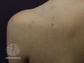 Acne affecting the back images (DermNet NZ acne-acne-back-161).jpg
