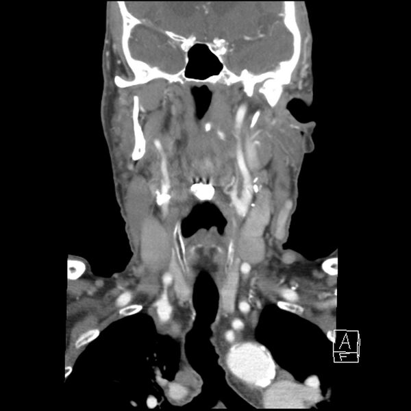 File:Acute ICA ischemic penumbra due to high-grade CCA stenosis (CT perfusion) (Radiopaedia 72038-82530 Coronal C+ arterial phase 18).jpg
