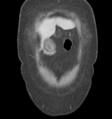 Acute acalculous cholecystitis (Radiopaedia 48250-53123 Coronal C+ portal venous phase 1).png