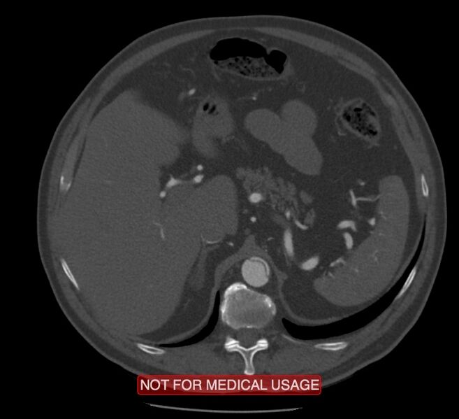 File:Acute aortic dissection - Stanford type A (Radiopaedia 40661-43285 Axial C+ arterial phase 83).jpg