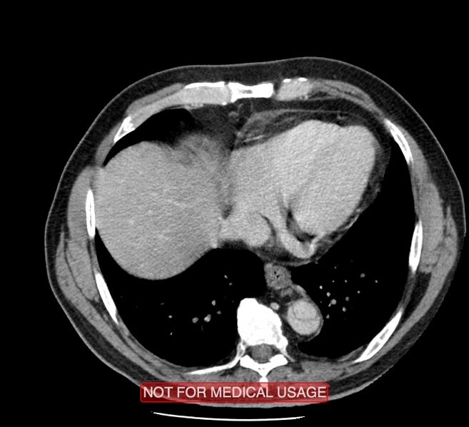 File:Acute aortic dissection - Stanford type A (Radiopaedia 40661-43285 Axial C+ portal venous phase 45).jpg