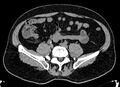 Acute appendicitis (Radiopaedia 13030-13091 Axial non-contrast 9).jpg