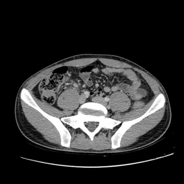 File:Acute appendicitis (Radiopaedia 27049-27227 Axial C+ portal venous phase 51).jpg