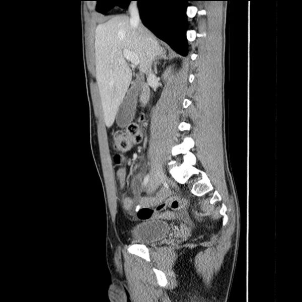 File:Acute appendicitis (Radiopaedia 27049-27227 Sagittal C+ portal venous phase 32).jpg