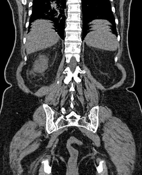 File:Acute appendicitis (Radiopaedia 58627-65818 Coronal non-contrast 53).jpg