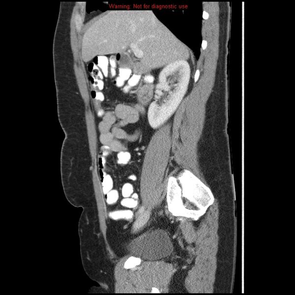 File:Acute appendicitis (Radiopaedia 7966-8812 B 3).jpg