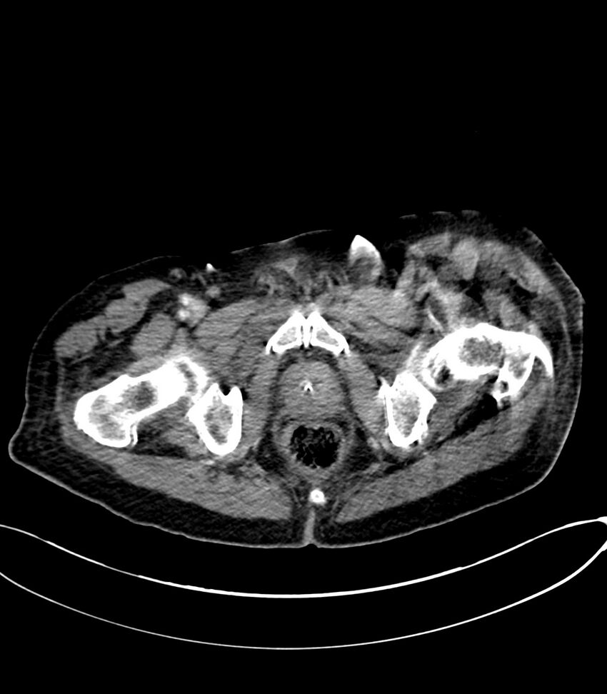Acute arterial mesenteric ischemia (Radiopaedia 78238-90828 Axial C+ portal venous phase 143).jpg