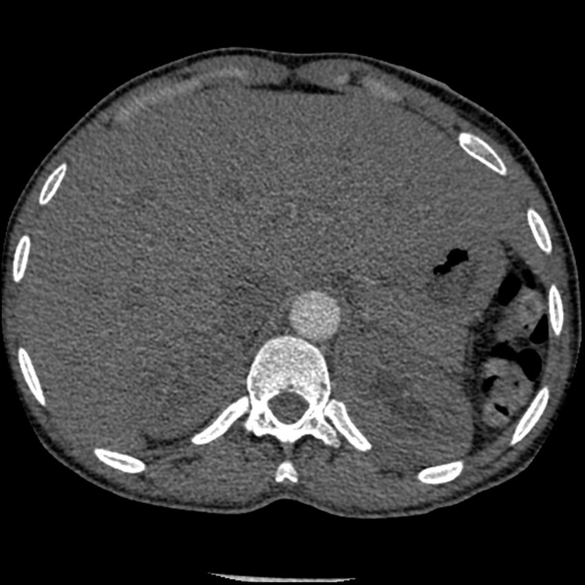 Acute chest syndrome - sickle cell disease (Radiopaedia 42375-45499 Axial C+ CTPA 190).jpg