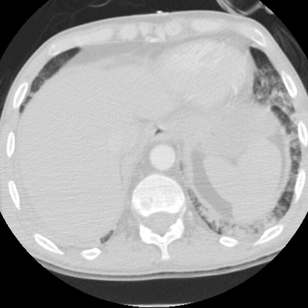 File:Acute diffuse alveolar hemorrhage (Radiopaedia 41323-44158 Axial lung window 56).jpg