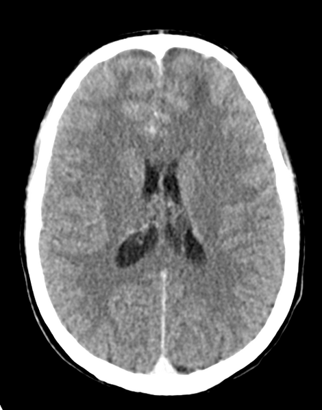 File:Acute disseminated encephalomyelitis (ADEM) (Radiopaedia 65319-74348 Axial C+ delayed 19).png