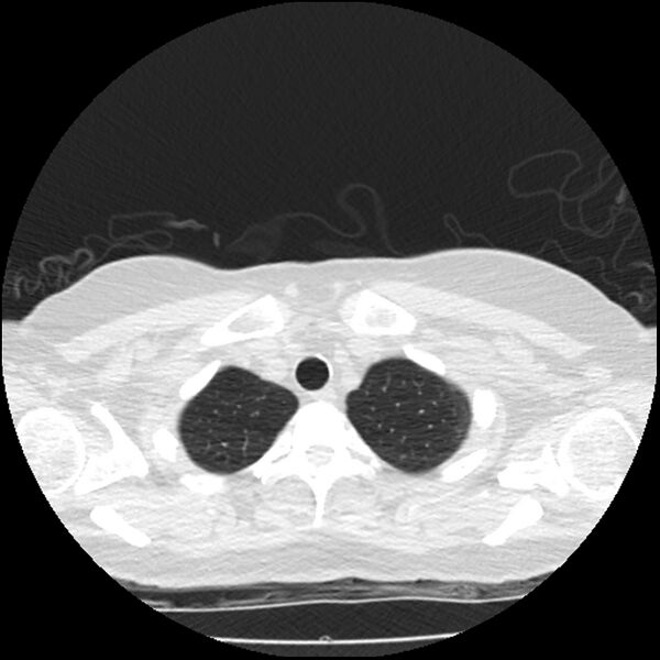 File:Acute interstitial pneumonitis (Radiopaedia 45404-49444 Axial lung window 11).jpg
