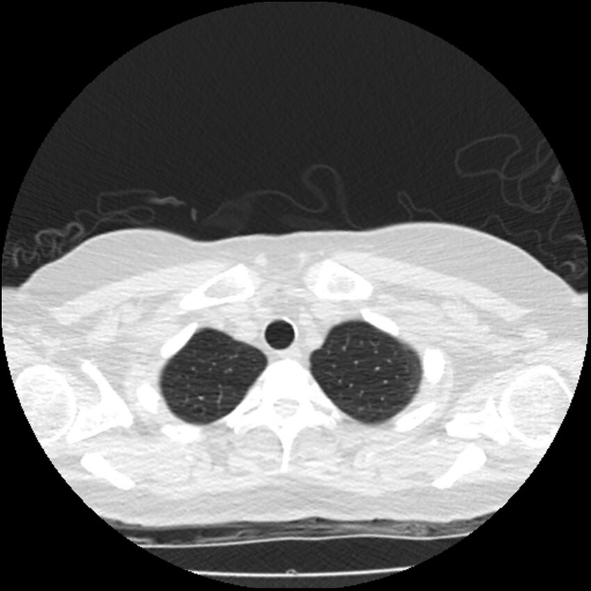 Acute interstitial pneumonitis (Radiopaedia 45404-49444 Axial lung window 11).jpg