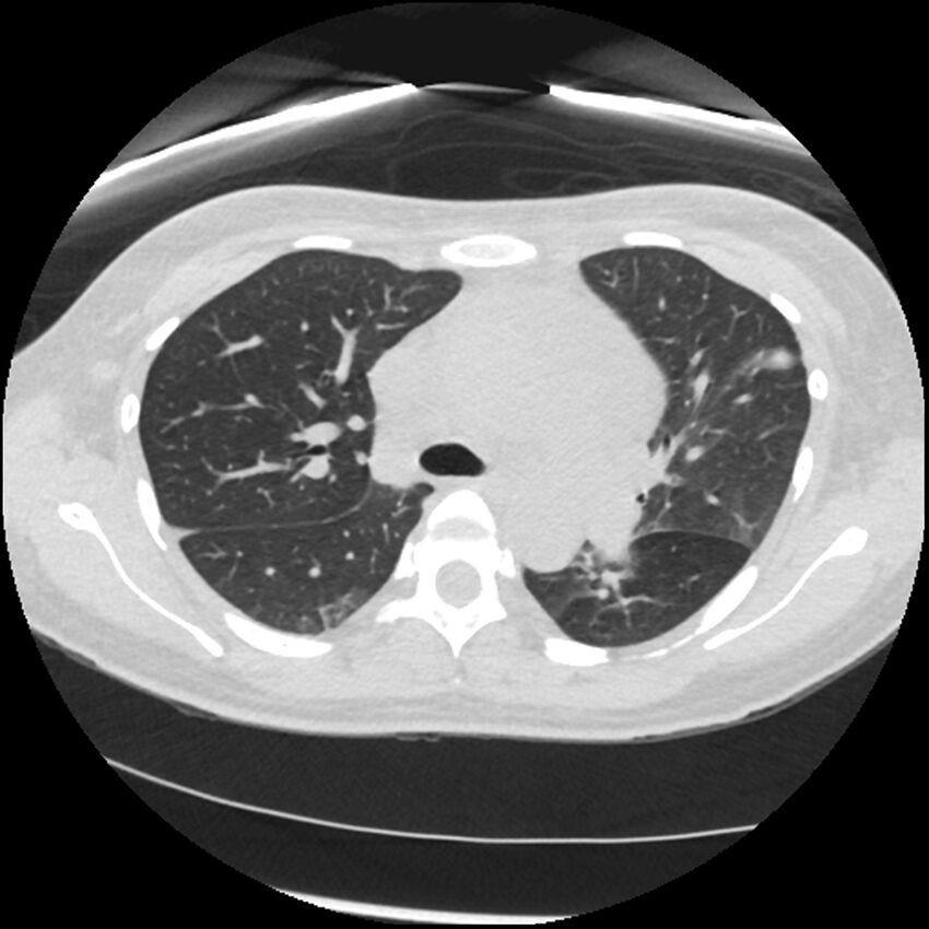 Acute lupus nephritis (Radiopaedia 45832-50107 Axial lung window 32).jpg