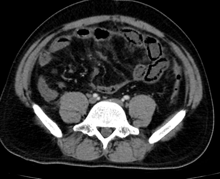File:Acute mesenteric ischemia - superior mesenteric artery thrombosis (Radiopaedia 73947-84776 Axial C+ arterial phase 106).jpg