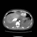 Acute myocarditis (Radiopaedia 55988-62613 Axial C+ portal venous phase 9).jpg