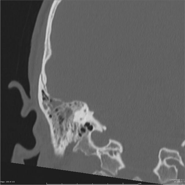 File:Acute otomastoiditis (Radiopaedia 28276-28512 Coronal PTB bone window reformat 39).jpg