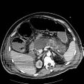 Acute pancreatic necrosis (Radiopaedia 13560-18502 Axial C+ portal venous phase 22).jpg