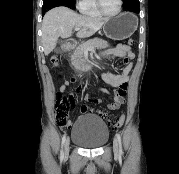 File:Acute pancreatitis (Radiopaedia 22572-22596 Coronal C+ portal venous phase 19).jpg
