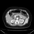 Acute pancreatitis - Balthazar C (Radiopaedia 26569-26714 Axial C+ arterial phase 28).jpg