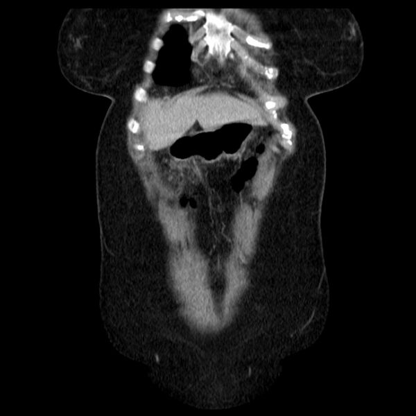 File:Acute pancreatitis - Balthazar C (Radiopaedia 26569-26714 Coronal C+ portal venous phase 15).jpg