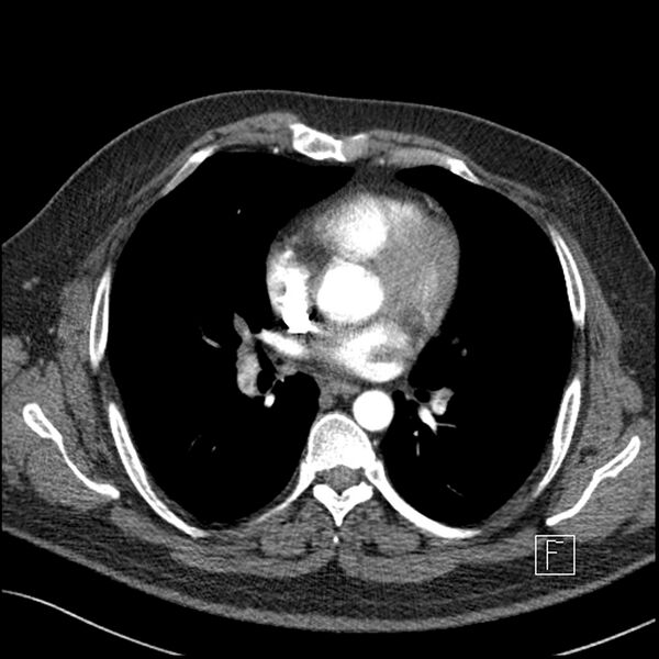 File:Acute pulmonary embolism with pulmonary infarct (Radiopaedia 73062-83768 Axial C+ CTPA 40).jpg