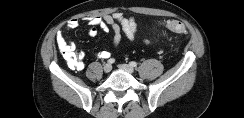 Acute sigmoid colon diverticulitis (Radiopaedia 55507-61976 Axial C+ portal venous phase 60).jpg