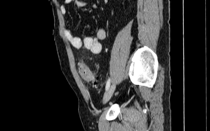 Acute sigmoid colon diverticulitis (Radiopaedia 55507-61976 Sagittal C+ portal venous phase 61).jpg