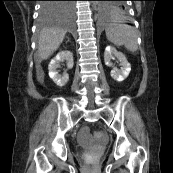 File:Acute tubular necrosis (Radiopaedia 28077-28334 D 59).jpg