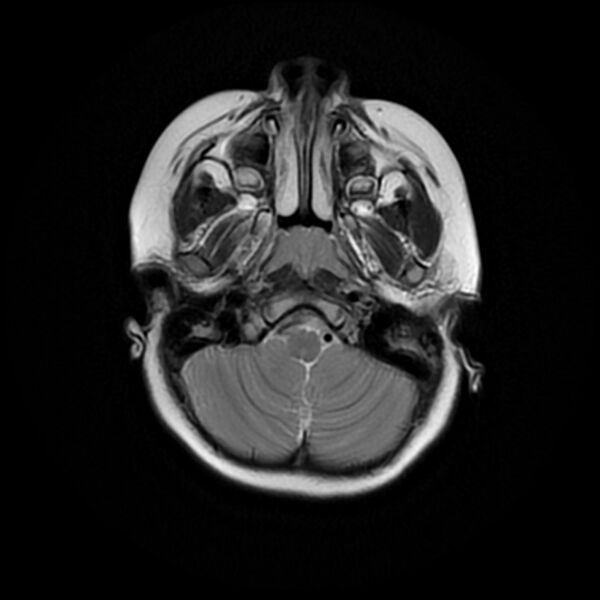File:Adamantinomatous craniopharyngioma (Radiopaedia 77407-89529 Axial T2 4).jpg