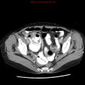 Adenocarcinoma of the colon (Radiopaedia 8191-9039 Axial liver window 65).jpg