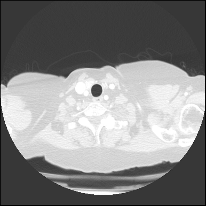 Adenocarcinoma of the lung (Radiopaedia 41015-43755 Axial lung window 2).jpg