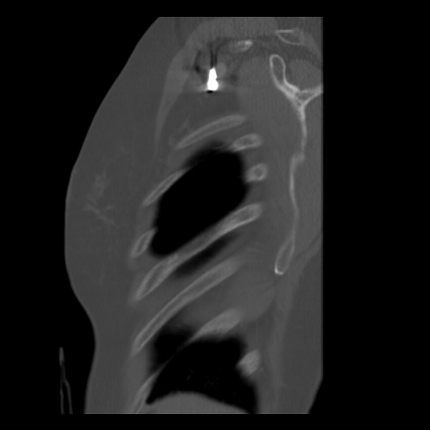 Adenocarcinoma of the lung (Radiopaedia 41015-43755 Sagittal bone window 5).jpg