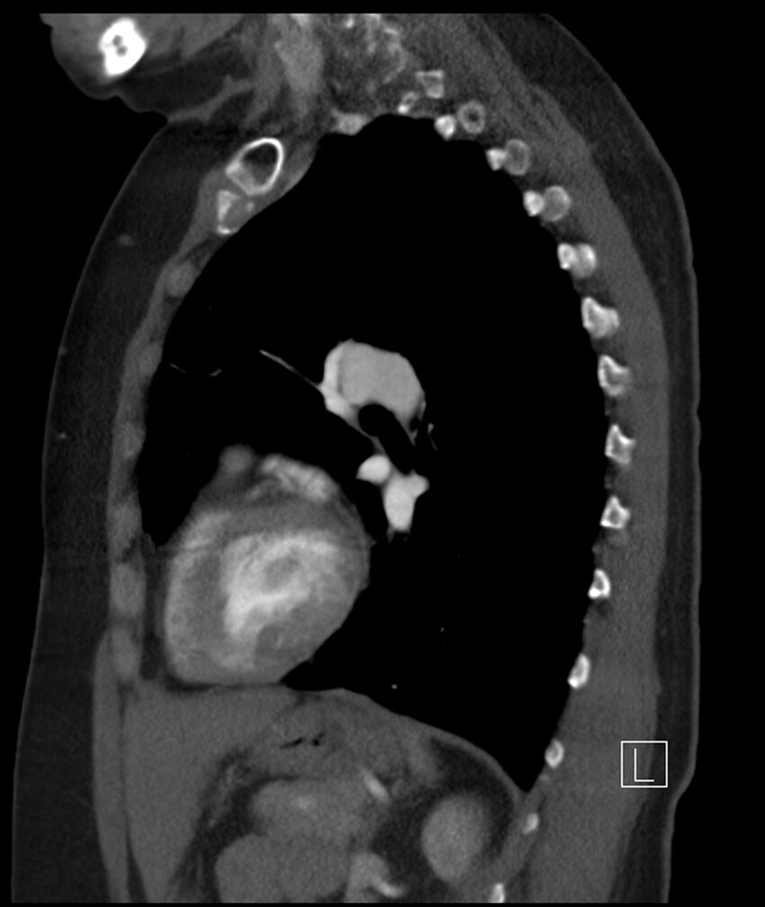 Adenocarcinoma of the lung (Radiopaedia 44205-47803 Sagittal C+ portal venous phase 22).jpg